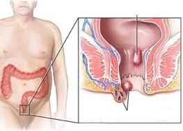 Hemoroidin belirtileri ve semptomları